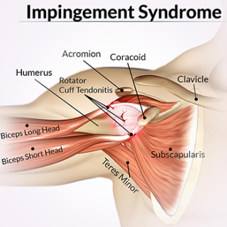 어깨충돌증후군 : 팔을 올리면 어깨가 아파요