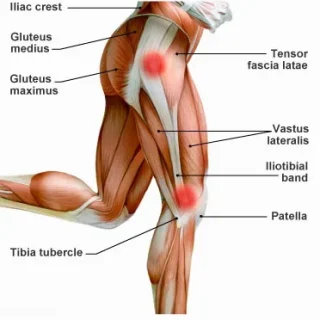 iliotibial band syndrome