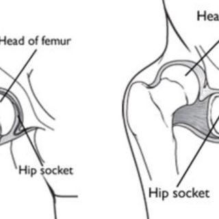 발달성 고관절 이형성증 : Developmental Dysplasia of the Hip, DDH 1