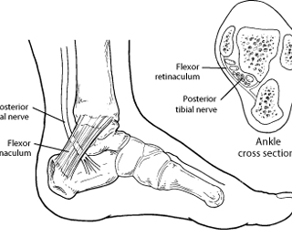 발목터널 증후군, Tarsal Tunnel Syndrome : 발이 저려요 8