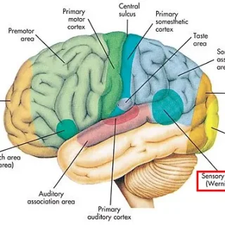 베르니케 실어증