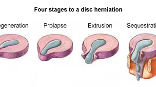 추간판 탈출증 : 허리통증질환 31