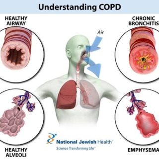 만성폐쇄성폐질환