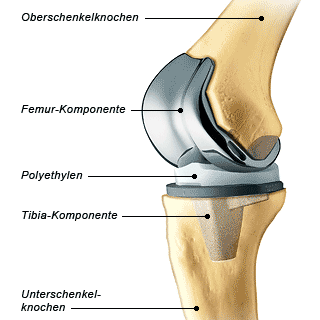 무릎인공관절수술 이란? 1