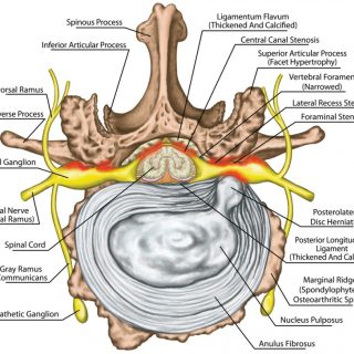 척추협착증이란 무엇인가? 1