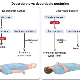 외상성 뇌손상, 근긴장 변화