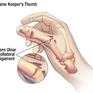 게임키퍼 엄지손가락(Gamekeeper·s thumb)이란? 101