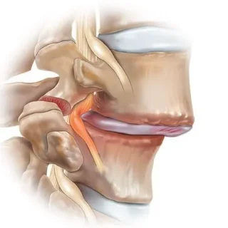 척추전방전위증 증상 및 단계 : spondylolisthesis 106