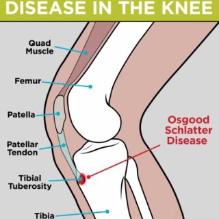 오스굿병 운동방법 7가지 : osgood-schlatter exercise 76