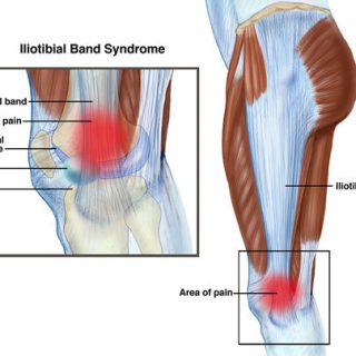 장경인대 증후군 증상 및 스트레칭 방법 6가지 1