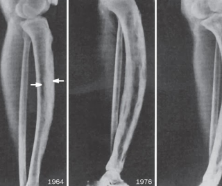 뼈의 파제트병 원인 골다공증과는 달라? Paget's disease 12