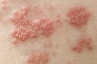 대상포진 후 신경통, postherpetic neuralgia 5