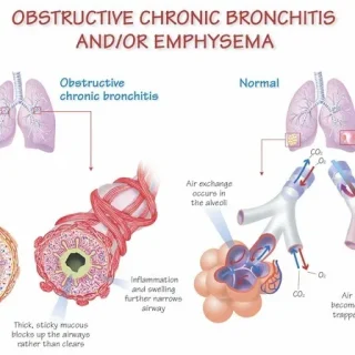 만성 폐쇄성 폐질환과 스테로이드 31