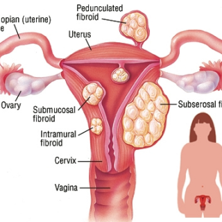 자궁근종의 유형과 원인 및 증상 : Uterine Fibroid 1