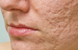 여드름 흉터 없애는 방법 1