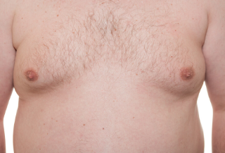 남성형 유방을 없애는 방법 이렇게? 1