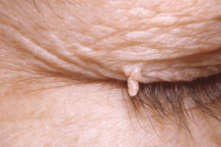 눈꺼풀 쥐젖의 원인과 제거, acrochordon, skin tag 9