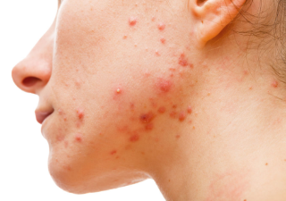 여드름 없애는 법 9가지 1