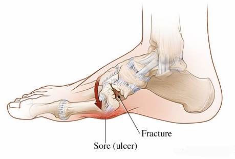 Charcot foot