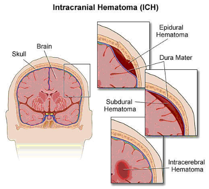 경막하혈종