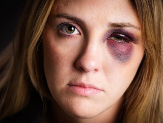 눈 주위 멍 같은 너구리눈의 원인 아시나요? Raccoon's Eye 1