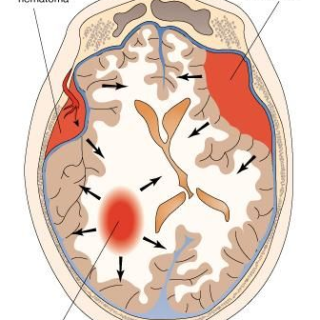 경막하혈종의 원인과 증상, Subdural Hematoma : SDH 1