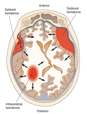 경막하혈종의 원인과 증상