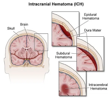경막하혈종