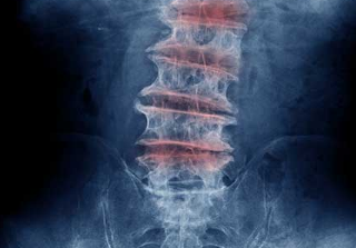 요추 관절염 원인과 증상, 치료방법 : Lumbar arthritis 18
