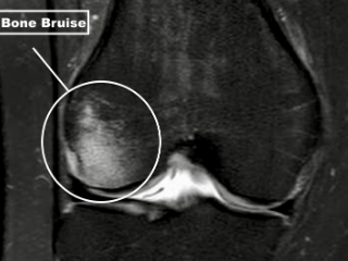 뼈에도 멍이 들어요? 뼈 타박상 증상 : bone bruise 12