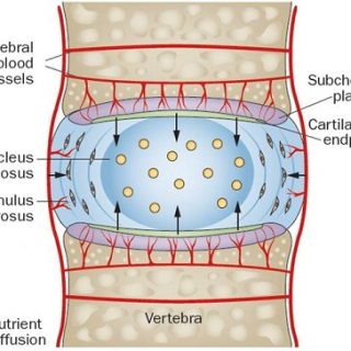 퇴행성 척추증 증상, Spondylosis : 퇴행성 추간판 질환 1