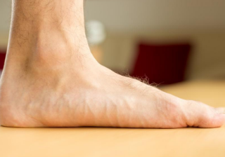 평발 치료 : 발이 불편한가요? Flat Feet, Fallen Feet 14