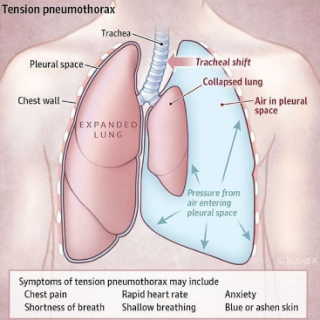 기흉 증상 : Pneumothorax, 흉벽과 폐 사이 공기가 참 22