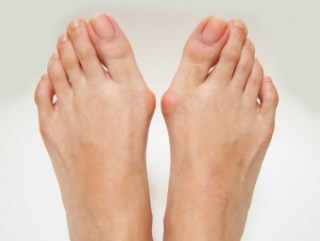 엄지발가락이 휘는 이유, 건막류, 무지외반증: Bunions, Hallux Valgus 83