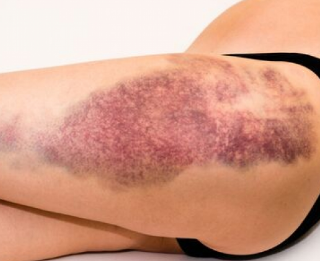 멍이 생기는 이유 : Bruising, Skin Bleeding 1