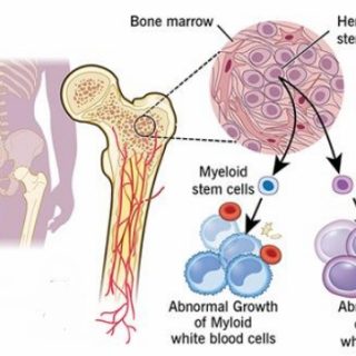 백혈병과 림프종의 차이점은? Leukemia and Lymphoma 5