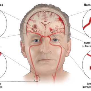 뇌졸중과 뇌동맥류 차이점은? Stroke and Aneurysm 12