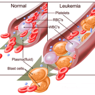 백혈병 증상 : 혈액 또는 골수의 암 : Leukemia 1