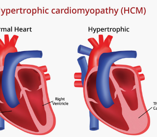 비대성 심근병증이란 무엇입니까? Hypertrophic Cardiomyopathy 1