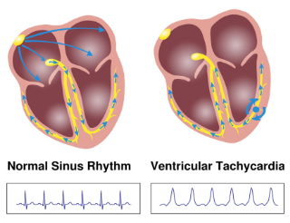 빈맥 원인 : 안정시 심박수가 빠른 것? Tachycardia 1