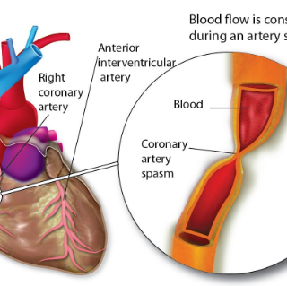 관상동맥연축 원인과 증상 : Coronary Artery Spasm 16