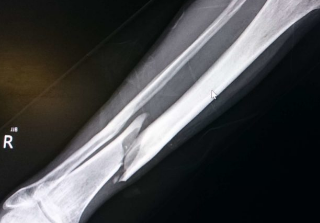 골절의 종류와 치료방법 1