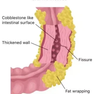 크론병 증상과 유당불내증의 차이점 26