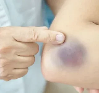 몸에 멍이 잘 드는 이유, 왜? 1