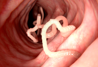 기생충 종류와 증상 4