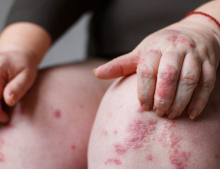 건선 치료 방법 : 해독이나 클렌징으로 가능? 5