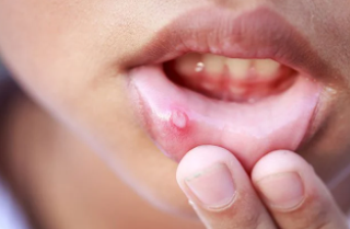 구내염 빨리 낫는 방법 있나요? 5