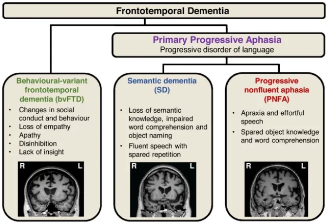 전두측두엽 치매 : 유형 및 단계-frontotemporal dementia 2 전두측두엽 치매