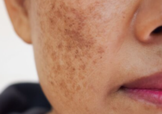 기미의 원인과 증상 5