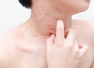 알레르기 반응이란 무엇입니까? 14